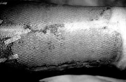 Fig. 1Homologous skin - temporary cover.&nbsp