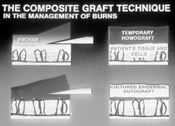 Fig. 2Cuomo Technique.