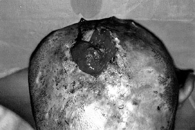 Fig. 1Pre-operative view of lesion.