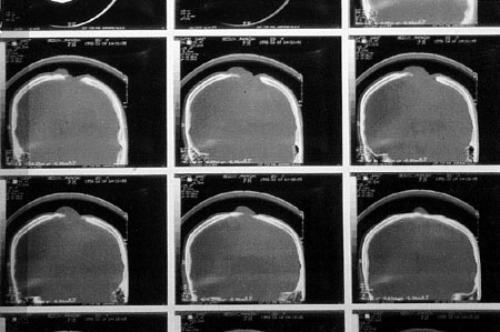 Fig. 2CT scan showing bone destruction.