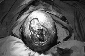 Fig. 3Intra-operative view after total excision of tumour.