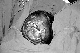 Fig. 4Intra-operative view after duraplasty.&nbsp
