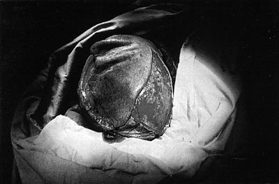 Fig. 5Intra-operative view after reconstruction of skin defect with scalp flap.