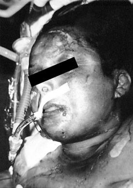 Fig. 134-yr old woman with deep burns in 22% BSA.