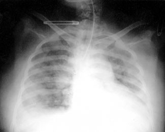 Fig. 2Lung X-ray, showing dilated  cardiac shadow, sign of congestion in minor circulation, and bilateral diffuse nonhomogeneous infiltrates.