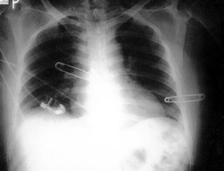 Fig. 3Lung X-ray showing regression of picture after treatment.