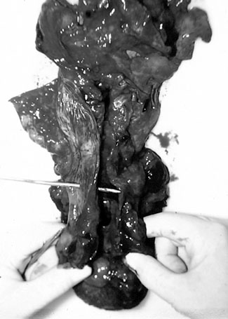 Fig. 4Tube inserted into tracheo-oesophageal fistula.