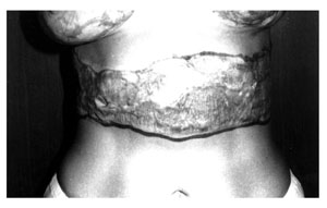 Fig. 2aSubtotal deformation of the abdominal wall.