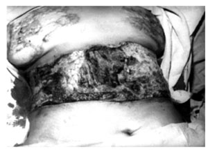Fig. 2bA stage of the operation.