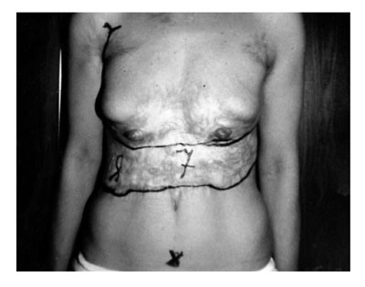 Fig. 3aCombined damage of the forward abdominal wall and mammary glans: patient before the operation.