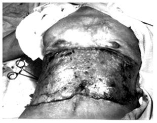 Fig. 3bThe same patient. A stage of the operation - 50% of cicatrices are excised