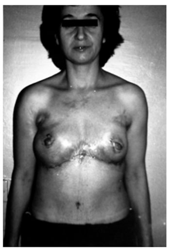 Fig. 3dFinal result of the operation.
