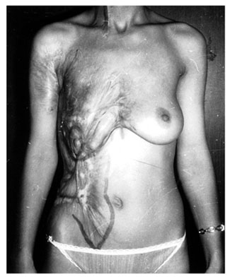 Fig. 4aPost-burn anterolateral deformity of the abdominal wall. Patient before the operation.