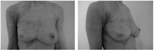 Fig. 4bReconstruction of anterolateral deformity: 7-year outcome.