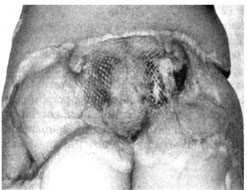 Fig. 5aScar deformity of the sacrolumbal region.
