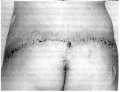 Fig. 5bResult of the operation after one month.