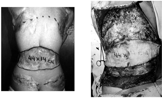Fig. 6aSite of the damaged tissue. Mobilized fasciocutaneous layers of back and gluteal region.