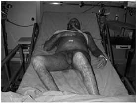 Fig. 1Diffuse erythematous, bullous, exfoliative reaction with associated purpuric lesions