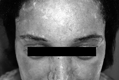 Fig. 2aCase 1. Follow-up at 18 months.Facial hypopigmentation and loss of cilia.