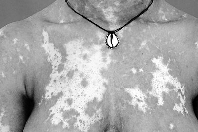 Fig. 2bCase 1. Follow-up at 18 months. Large hypochromic spots in the thorax and upper limbs