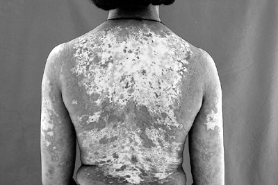 Fig. 2cCase 1. Follow-up at 18 months. Hypertrophic scarring and hypopigmentation in the back.