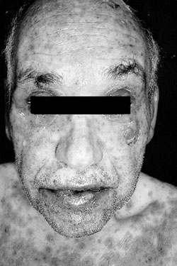 Fig. 3aCase 2. Aspect of patient on admission to burns unit. Ocular and facial involvement.