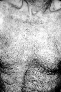 Fig. 3bCase 2. Aspect of patient on admission to burns unit. Thorax involvement showing target lesions.
