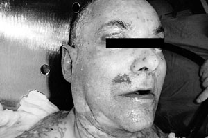 Fig. 4aCase 2. Patient at end of first week in burns unit. Ocular and facial involvement.
