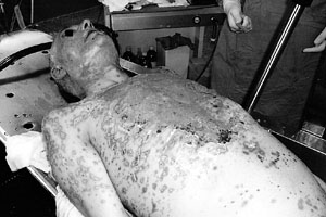 Fig. 4bCase 2. Patient at end of first week in burns unit. Thorax involvement and application of epidermal substitutes.