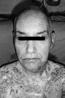 Fig. 5aCase 2. Follow-up at two months. Ocular and facial aspect.