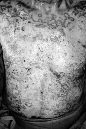 Fig. 5bCase 2. Follow-up at two months. Thorax aspect, showing hypertrophic scarring and hypochromia.
