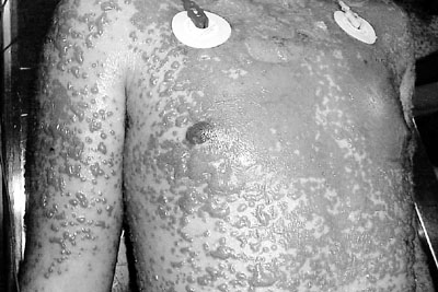 Fig. 6aCase 3. Thoracic lesions. Aspect during hospitalization in burns unit, showing bullae confluence and sloughing of skin.