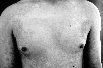 Fig. 6bCase 3. Thoracic lesions. Follow-up at three months.
