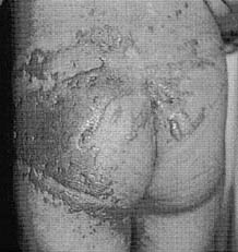 Fig. 3Full-thickness burns.