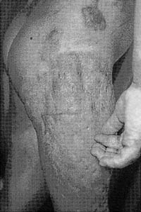 Fig. 4Full-thickness burns.