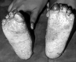Fig. 1Feet of 2-yr-old boy made to walk on hot cinders - deep partial-thickness burns in soles of feet with infection.