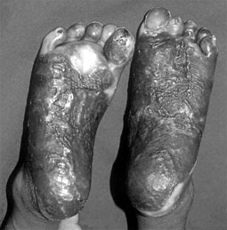 Fig. 2Feet of same child after treatment and split-skin grafting.