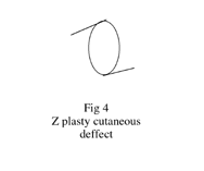 Fig. 4Z-plasty for cutaneous defect.
