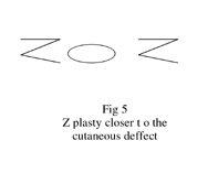 Fig. 5Z-plasty closer to the cutaneous defect.