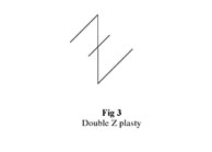 Fig. 3Double Z-plasty