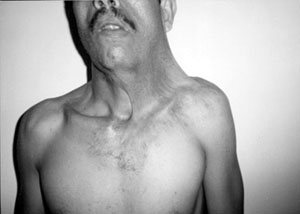 Fig. 7Cervico-facial scar (burns sequelae).
