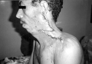 Fig. 9After Z-plasty. 