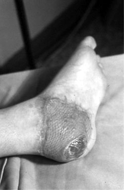 Fig. 3Secondary heel ulceration in the split-thickness skin graft.