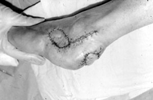 Fig. 4Lateral island heel flap by Grabb and Argenta.