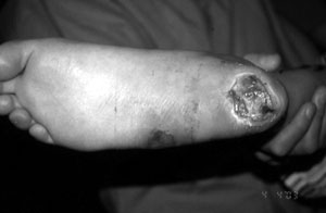 Fig. 6Heel ulceration.
