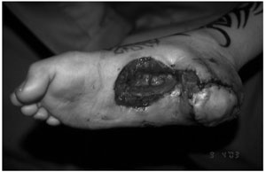 Fig. 7Reconstruction of the heel.