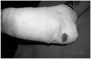 Fig. 8Fenestration in the dressing on the heel to control flap perfusion.