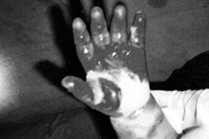 Fig. 1aEnfant victime d�une br�lure �lectrique par bas voltage, de 2�me degr� superficiel, de la face palmaire de sa main gauche.