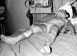 Fig. 1Patient with burns on the 60% TSBA.