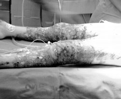 Fig. 2Detail of lower limbs with deep eschars.